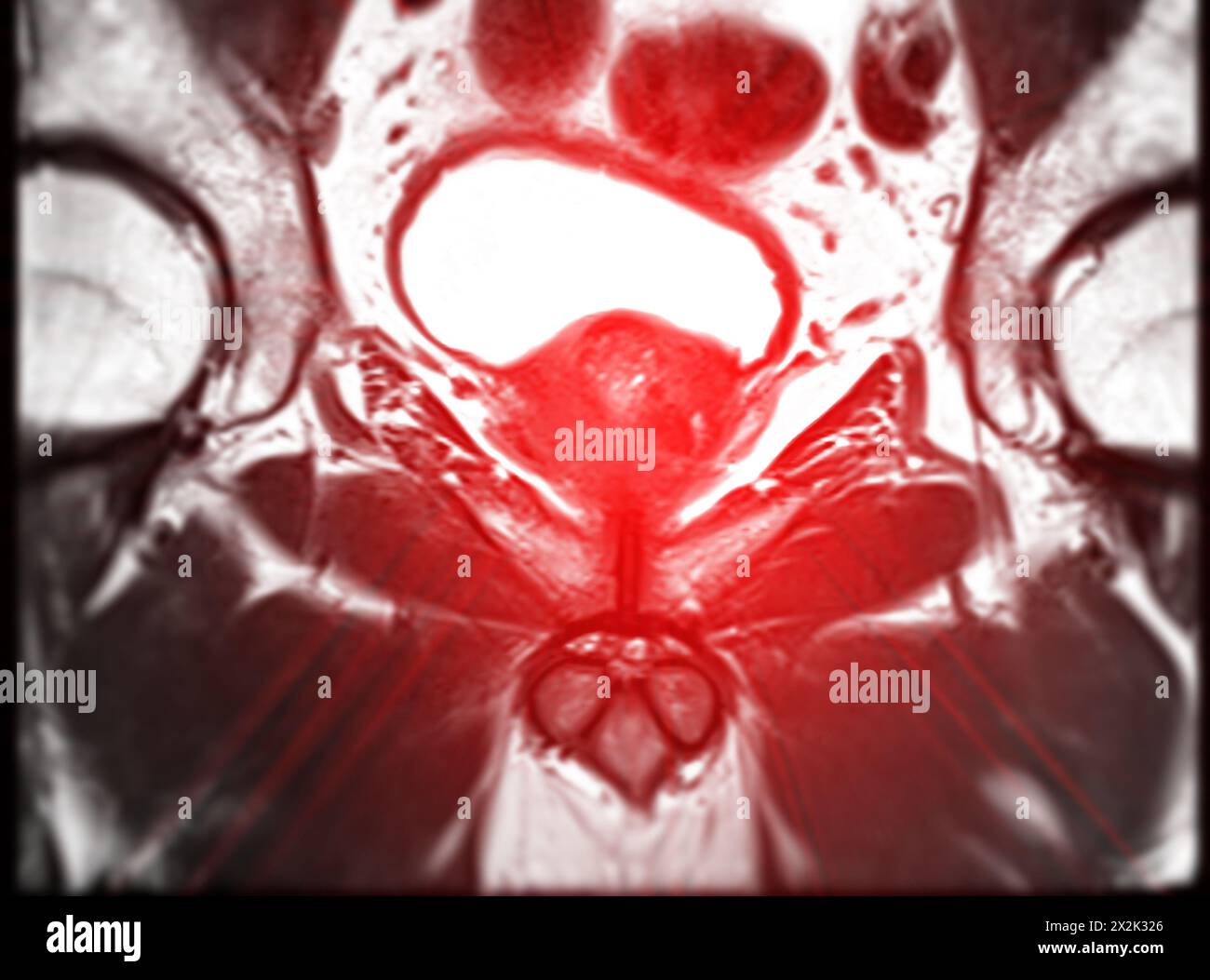 La risonanza magnetica della ghiandola prostatica rivela una lesione si oculare anomala al PZpl sinistro all'apice come descritto; PI-RADS categoria 4, cancro clinicamente significativo è li Foto Stock