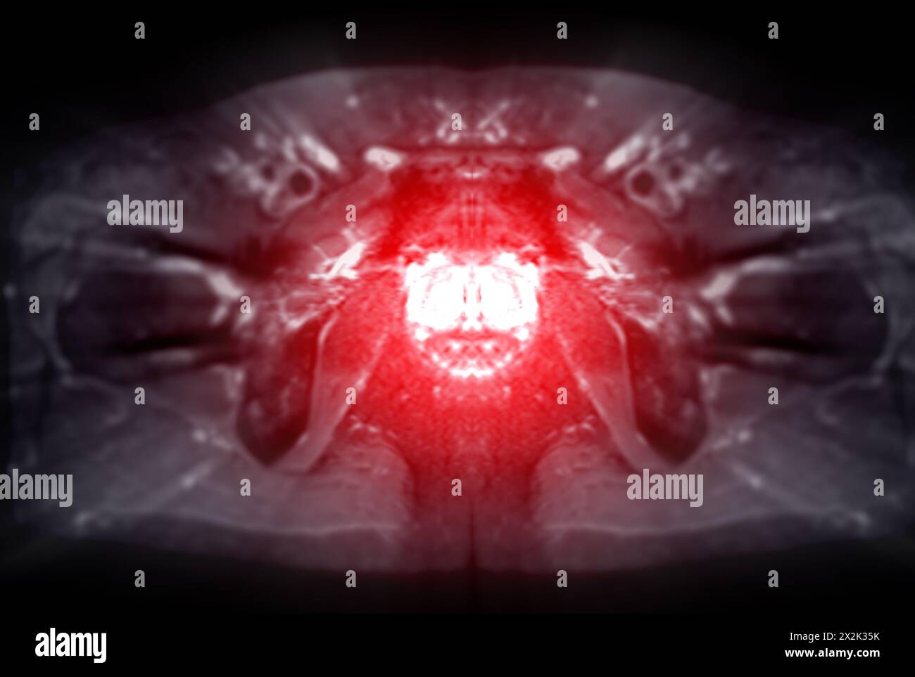 La risonanza magnetica della ghiandola prostatica rivela una lesione si oculare anomala al PZpl sinistro all'apice come descritto; PI-RADS categoria 4, cancro clinicamente significativo è li Foto Stock