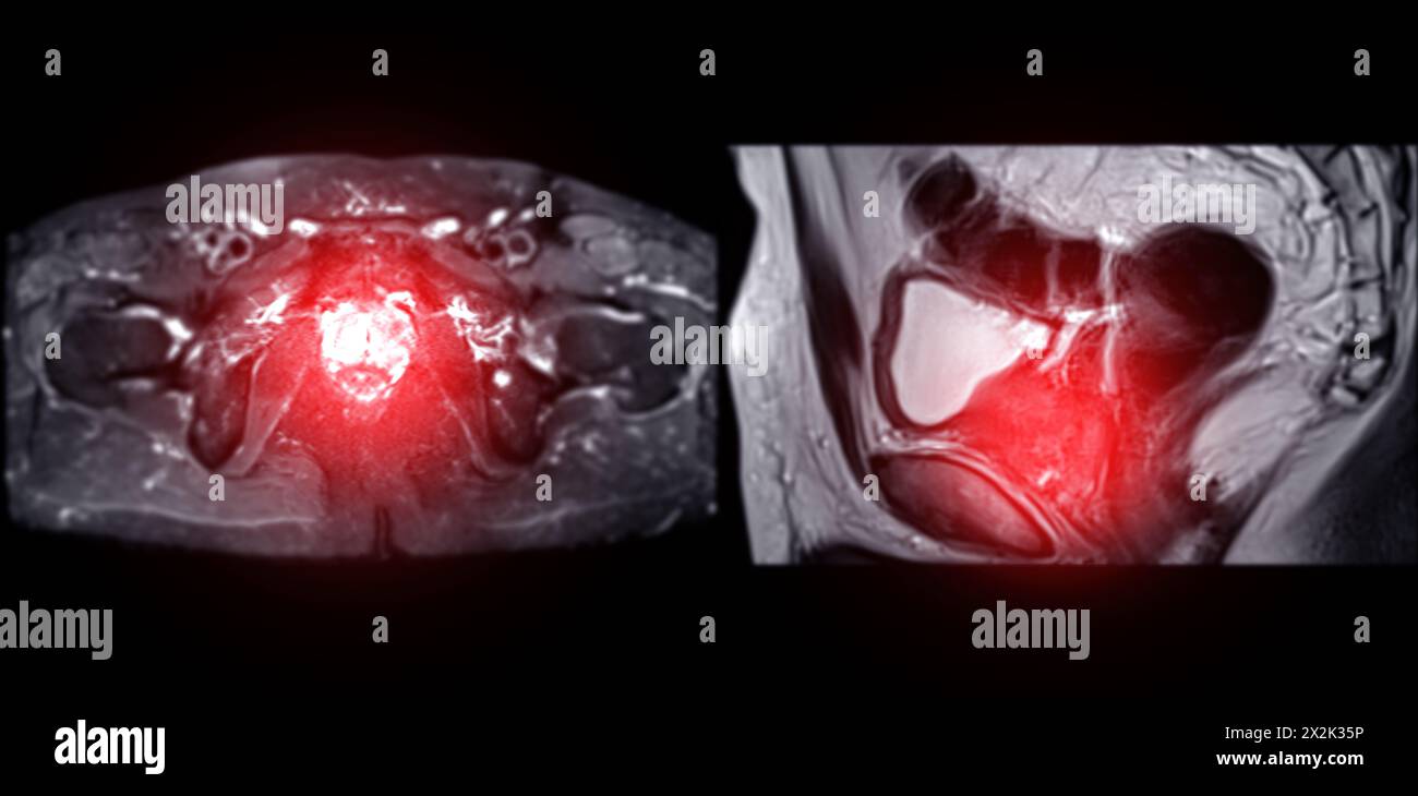 La risonanza magnetica della ghiandola prostatica rivela una lesione si oculare anomala al PZpl sinistro all'apice come descritto; PI-RADS categoria 4, cancro clinicamente significativo è li Foto Stock