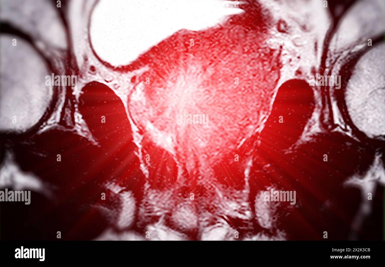 La risonanza magnetica della ghiandola prostatica rivela una lesione focale di intensità del segnale anomala (si) nelle zone periferiche posterolaterali sinistre all'apice, favorendo il diam Foto Stock