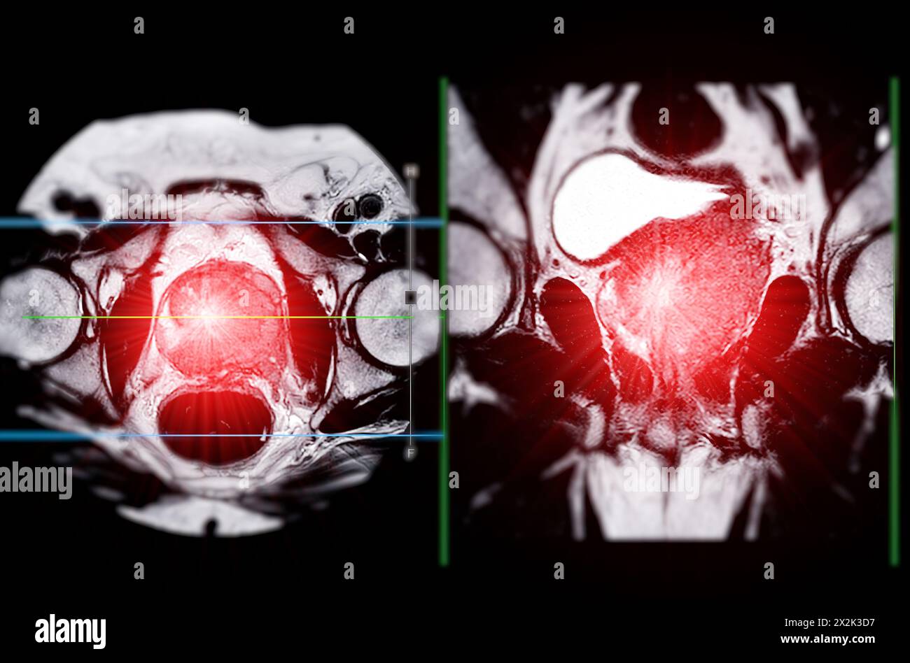 La risonanza magnetica della ghiandola prostatica rivela una lesione focale di intensità del segnale anomala (si) nelle zone periferiche posterolaterali sinistre all'apice, favorendo il diam Foto Stock