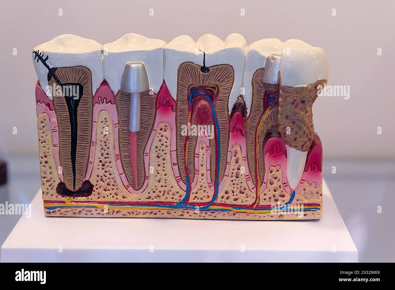 Modello con campioni di trattamento e protesi di denti umani. Medicina Foto Stock