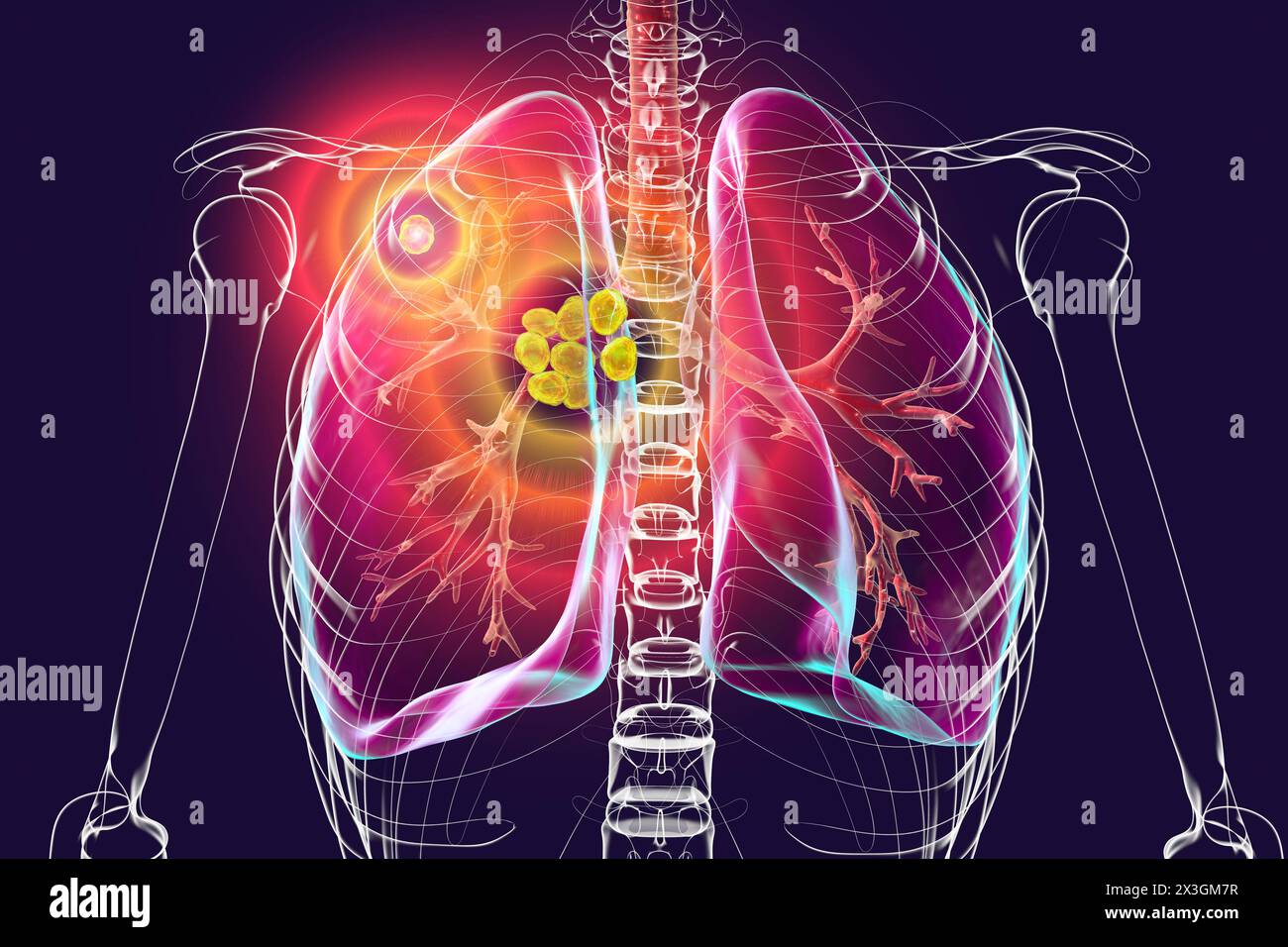 Illustrazione della tubercolosi polmonare primaria, con complesso Ghon e linfoadenite mediastinica. Foto Stock