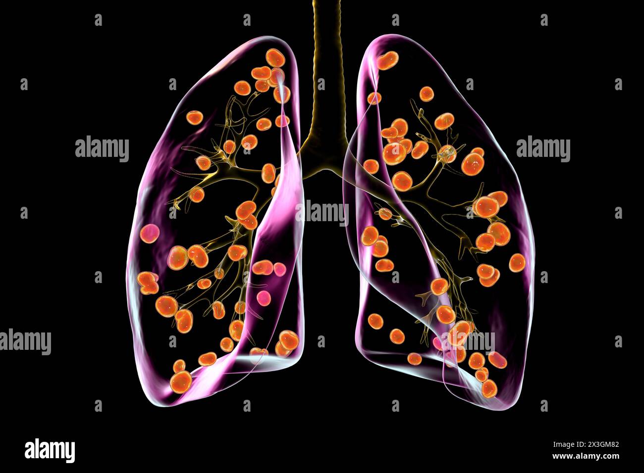 Illustrazione dell'istoplasmosi polmonare, un'infezione fungina causata dall'Histoplasma capsulatum, che mostra piccoli noduli sparsi in tutti i polmoni. Foto Stock