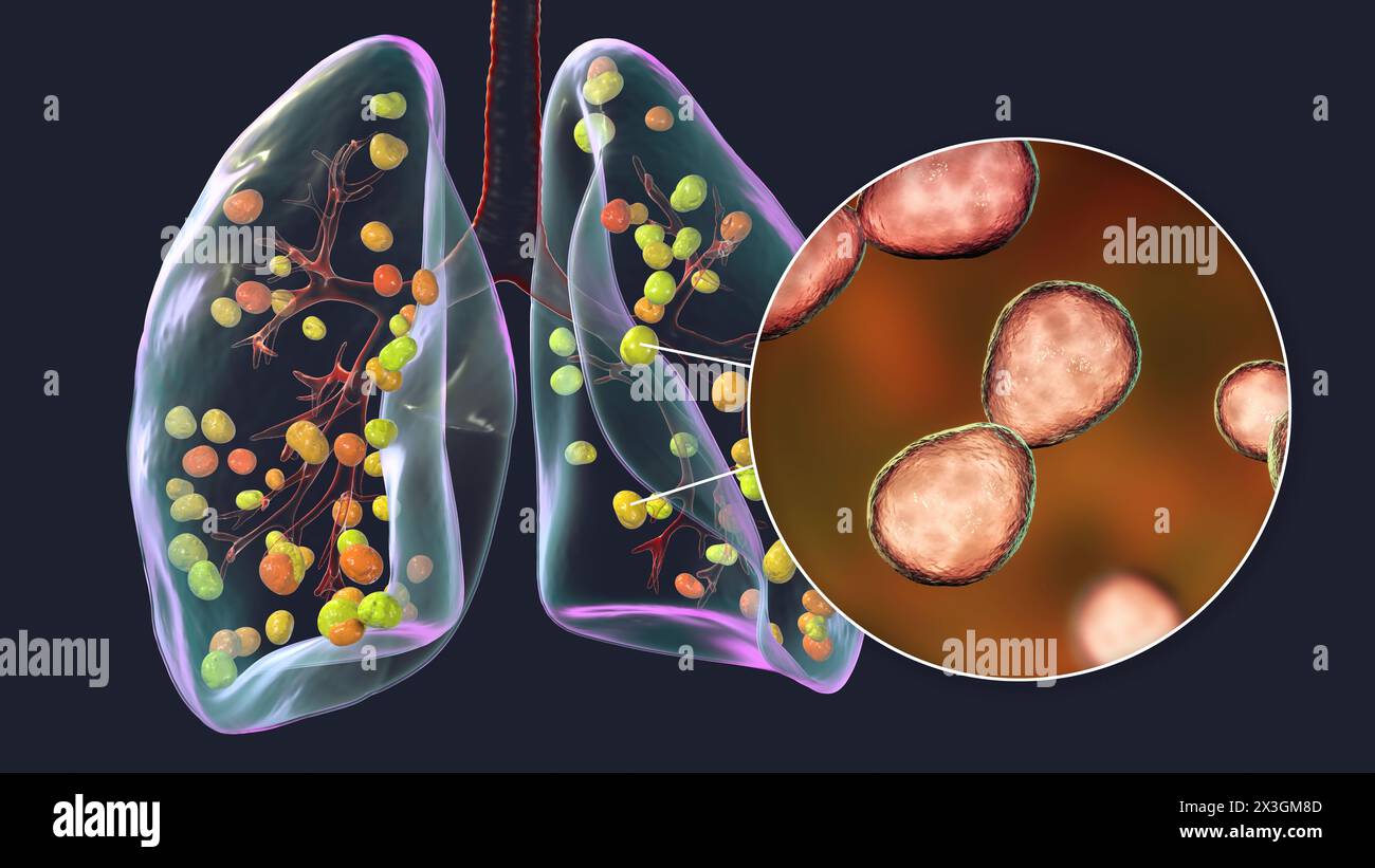 Illustrazione dell'istoplasmosi polmonare, un'infezione fungina causata dall'Histoplasma capsulatum, che mostra piccoli noduli sparsi nei polmoni e vista ravvicinata dei lieviti istoplasmatici. Foto Stock