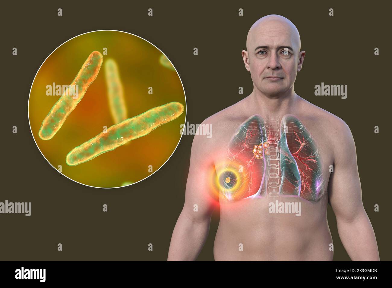 Illustrazione di un uomo con tubercolosi polmonare primaria, che rivela il complesso di Ranke, evidenzia lesioni polmonari e linfoadenite mediastinica, insieme a una vista ravvicinata dei batteri Mycobacterium tuberculosis. Foto Stock