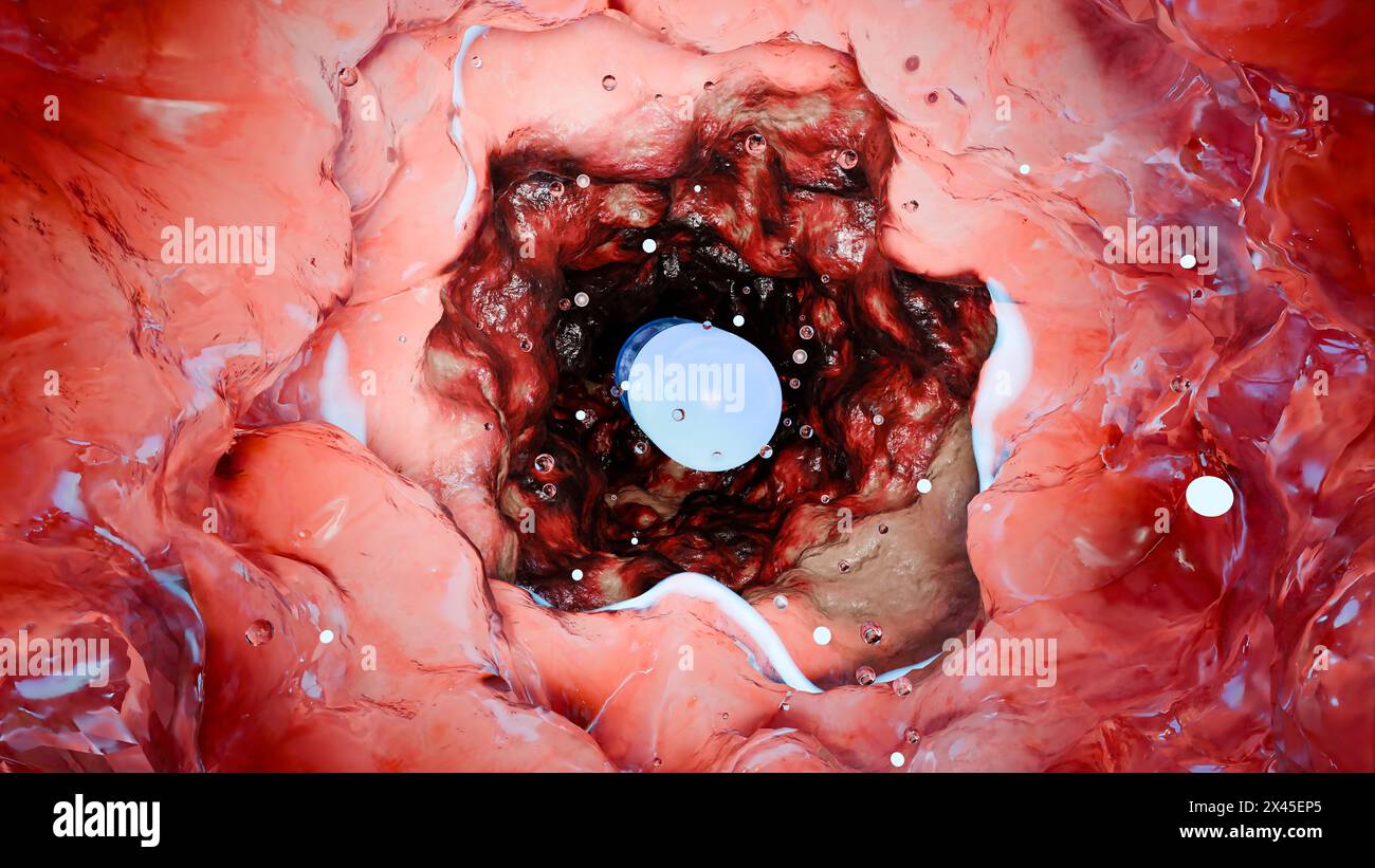 Probiotici nel tratto intestinale. endoscopia attraverso l'intestino. Microbiota, Capsula per pillole con vitamine per l'apparato digerente, trattamento del dolore allo stomaco, Rosso Foto Stock