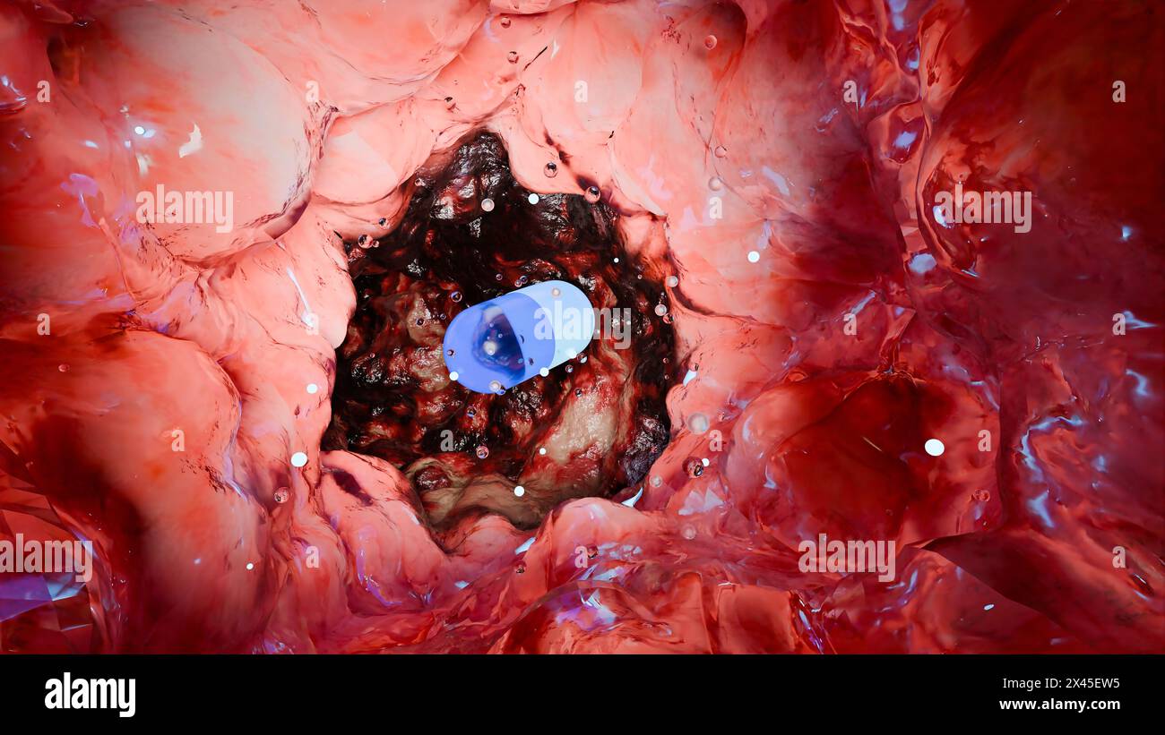 Probiotici nel tratto intestinale. endoscopia attraverso l'intestino. Microbiota, Capsula per pillole con vitamine per l'apparato digerente, trattamento del dolore allo stomaco, Rosso Foto Stock