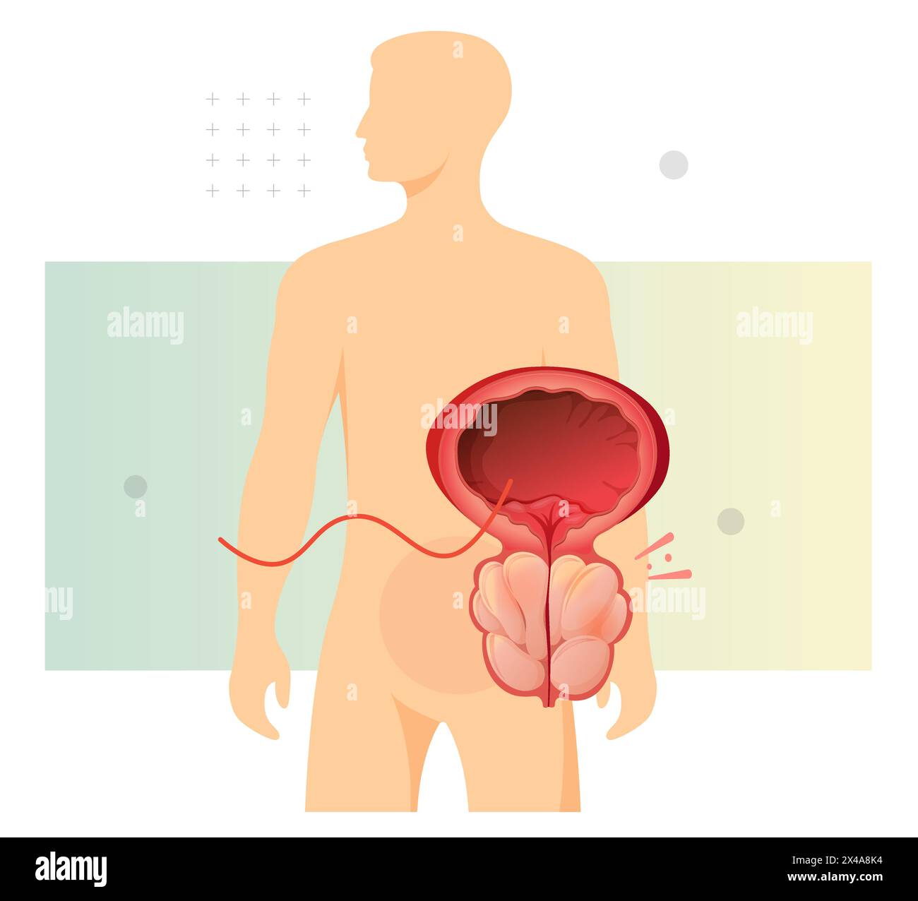 Prostata normale e ghiandola prostatica ingrandita sotto vescica - illustrazione stock come file EPS 10 Illustrazione Vettoriale