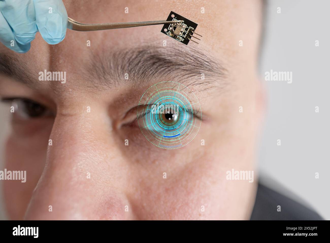 Installazione di chip elettronici in occhio bionico umano, neuroprotesico, tecnologia all'avanguardia, progresso tecnologico visionario, ripristinare la vista Foto Stock