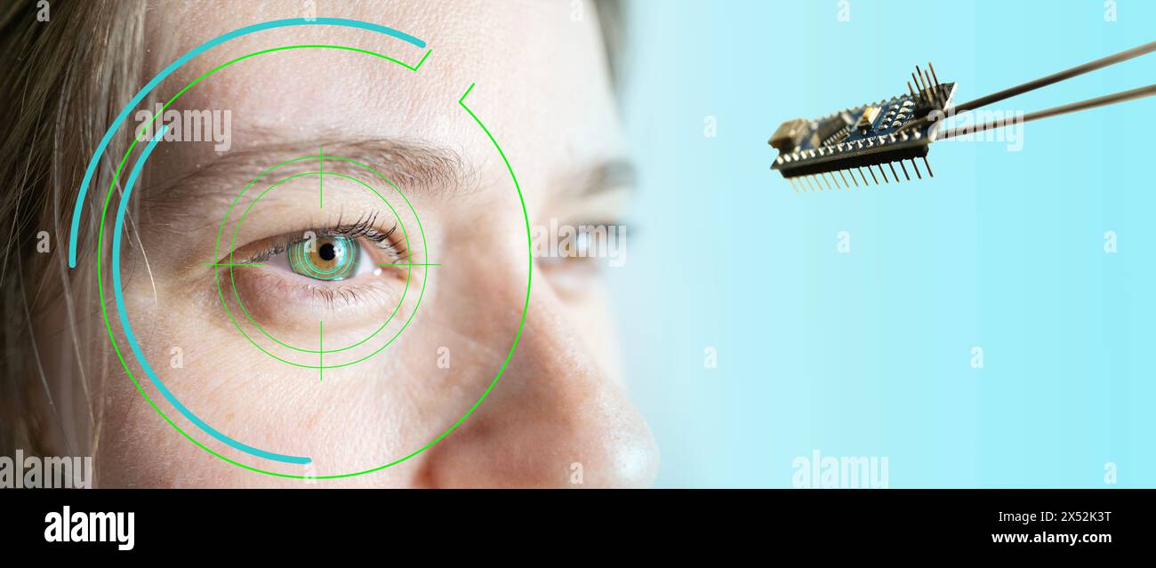 Installazione di chip elettronici in occhio bionico, neuroprotesico umano, tecnologia all'avanguardia, visione futuristica, ripristinare la vista Foto Stock