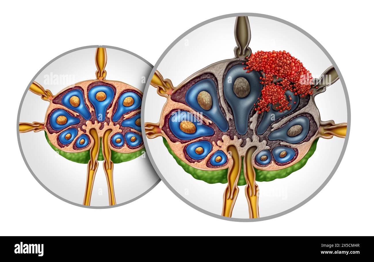 Linfoma linfonodo cancro anatomia diffusione nel sistema linfatico come tumore nei nodi come concetto del sistema immunitario o malattia linfoide. Foto Stock