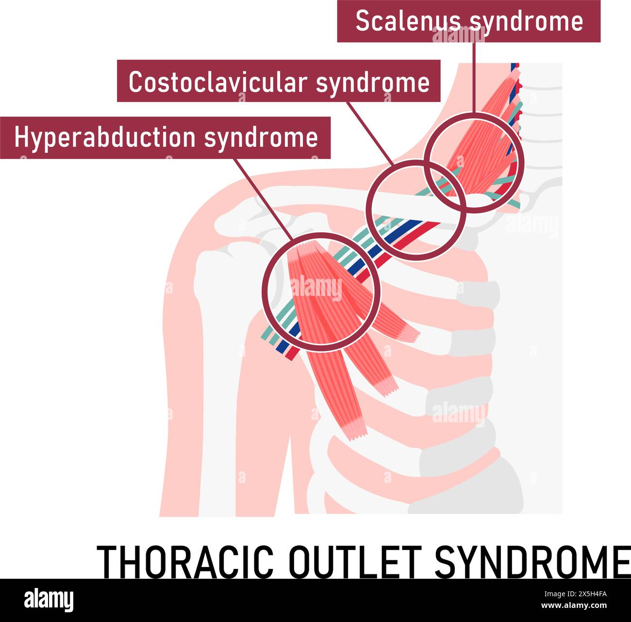 Illustrazione vettoriale di dove si verifica la sindrome dello sbocco toracico Illustrazione Vettoriale