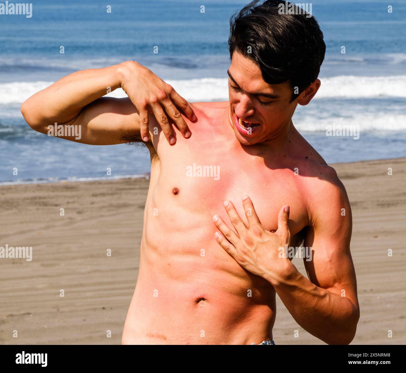 Giovane che controlla le sue gravi scottature mentre è in spiaggia, esprimendo disagio. Foto Stock