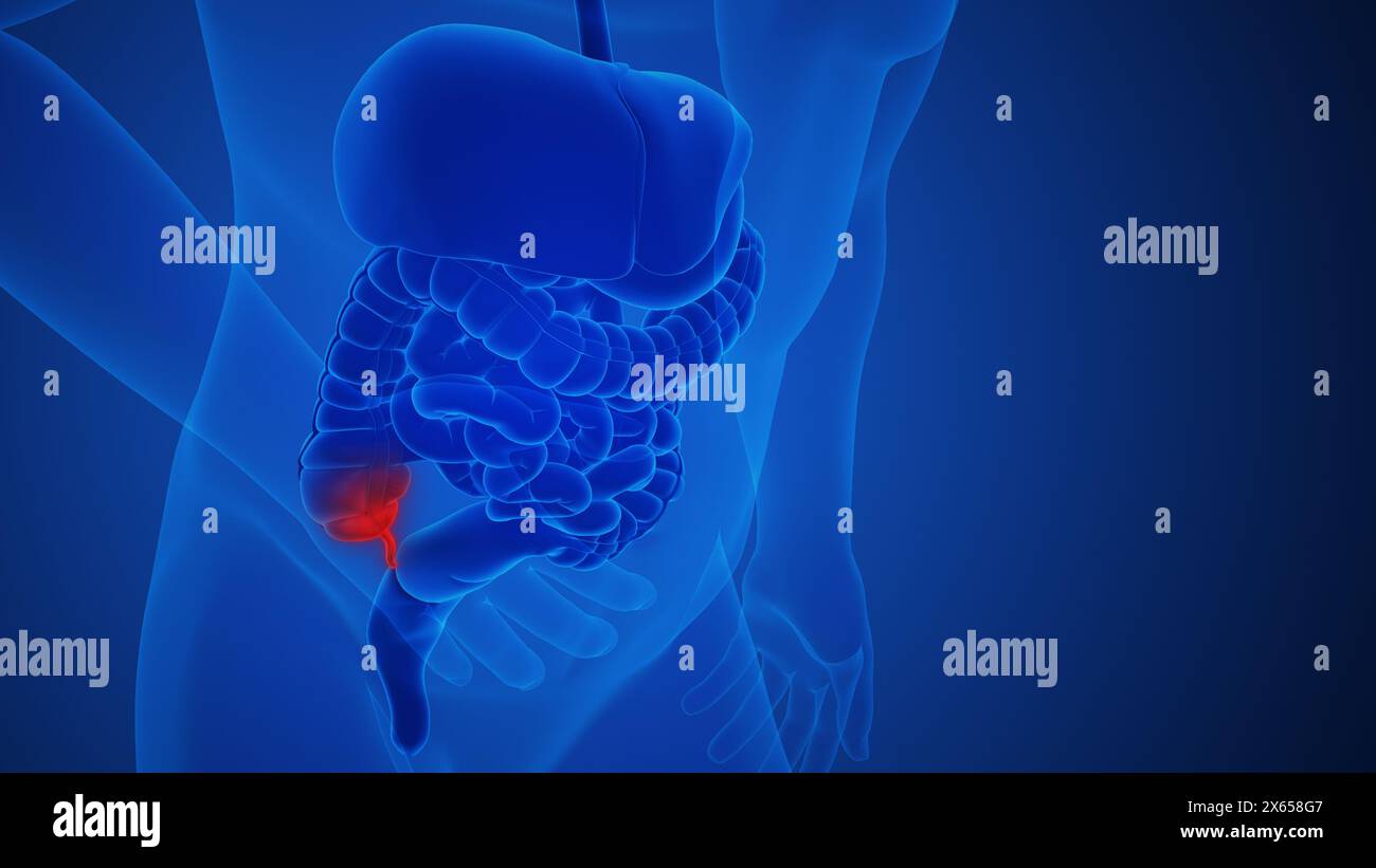 Appendice infiammazione dolore anatomia per concetto medico Foto Stock