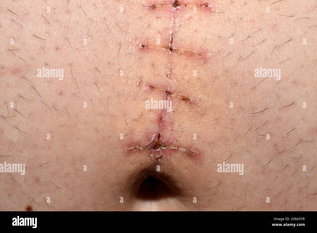 Guarigione della sutura chirurgica dopo la rimozione di un'ernia ombelicale sull'addome di un uomo, primo piano. Foto Stock