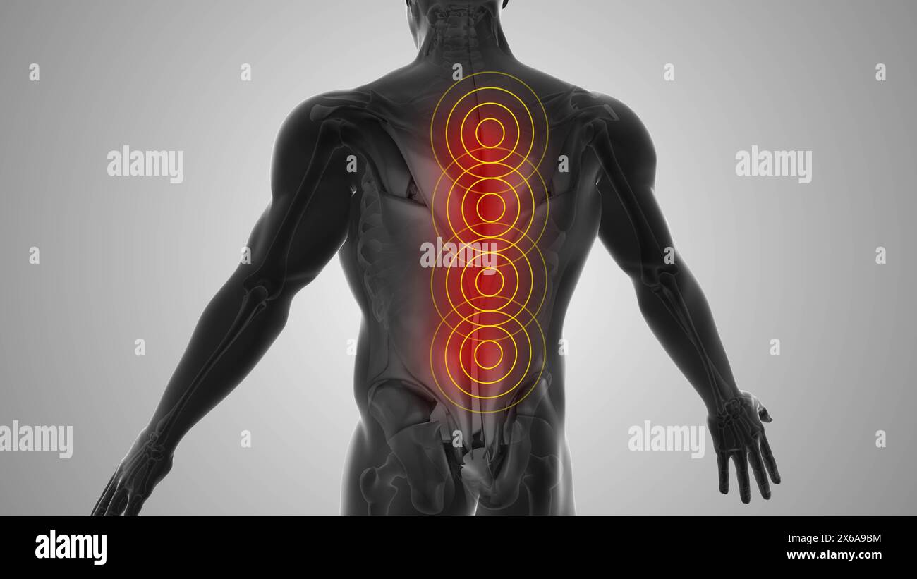 Fastidio alla schiena che innesca il dolore Foto Stock