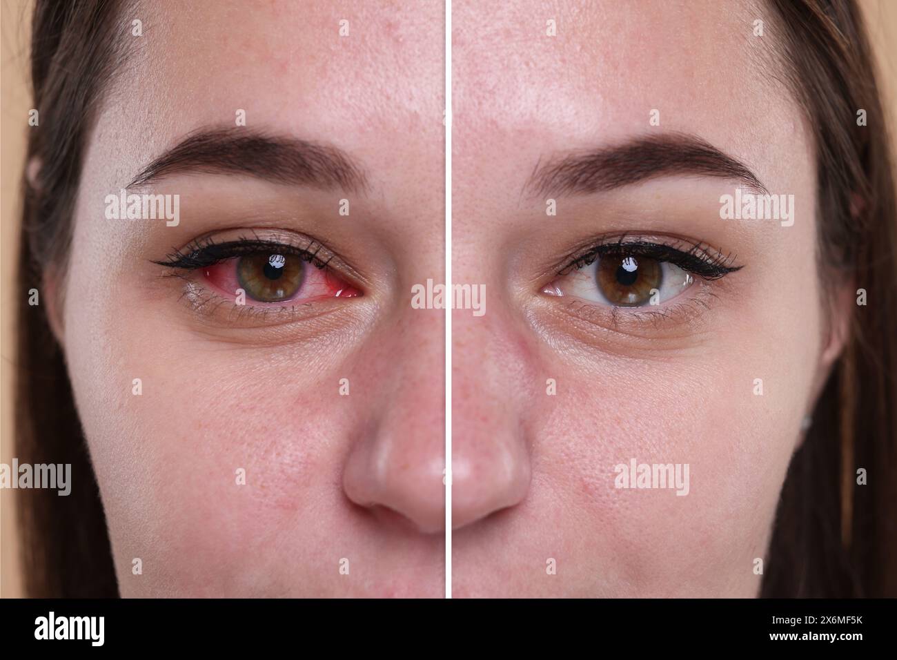 Prima e dopo il trattamento con congiuntivite. Foto di donna con occhi rossi e sani, collage Foto Stock