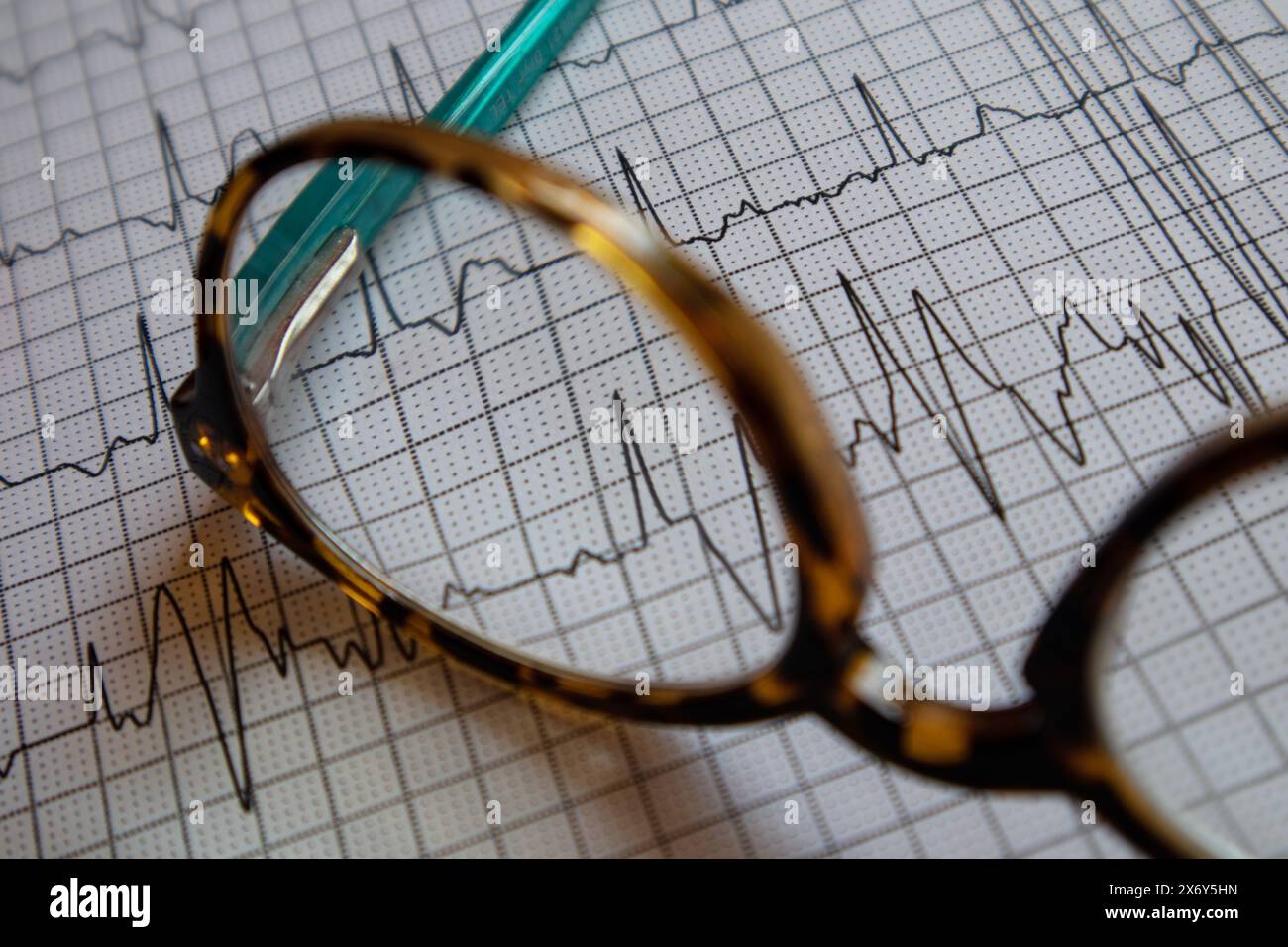 Referti ECG ECG ECG stampati su fogli. Un paio di occhiali da lettura Foto Stock