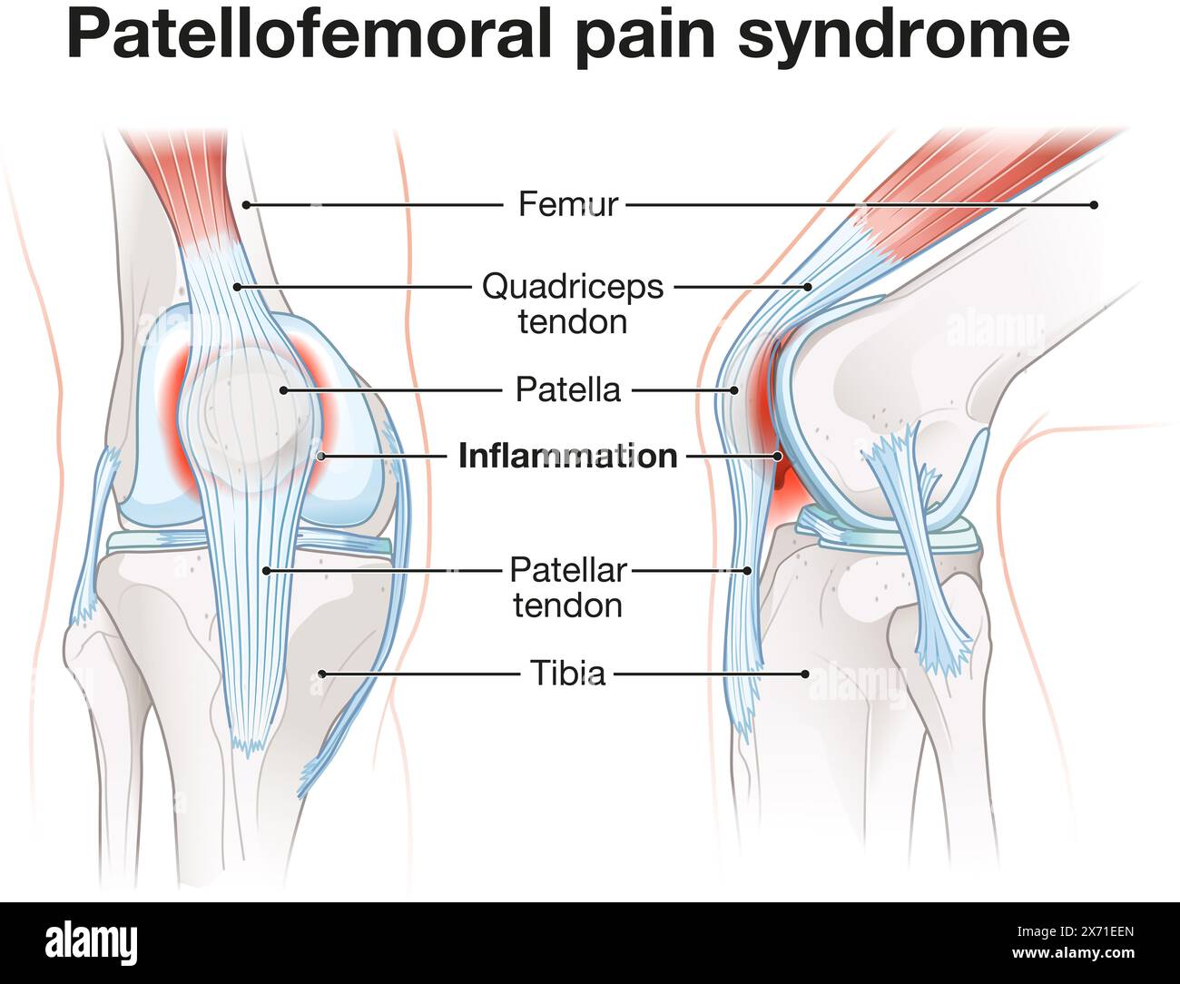 La sindrome da dolore patellofemorale comporta disagio al ginocchio dovuto a malallineamento, infiammazione e disfunzione dell'articolazione patellofemorale durante il movimento. Foto Stock
