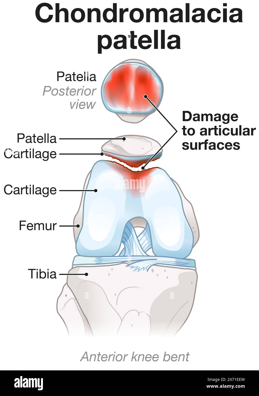 La condromalacia comporta l'ammorbidimento e il deterioramento della cartilagine, causando spesso dolore al ginocchio, infiammazione e disagio durante il movimento e l'attività Foto Stock