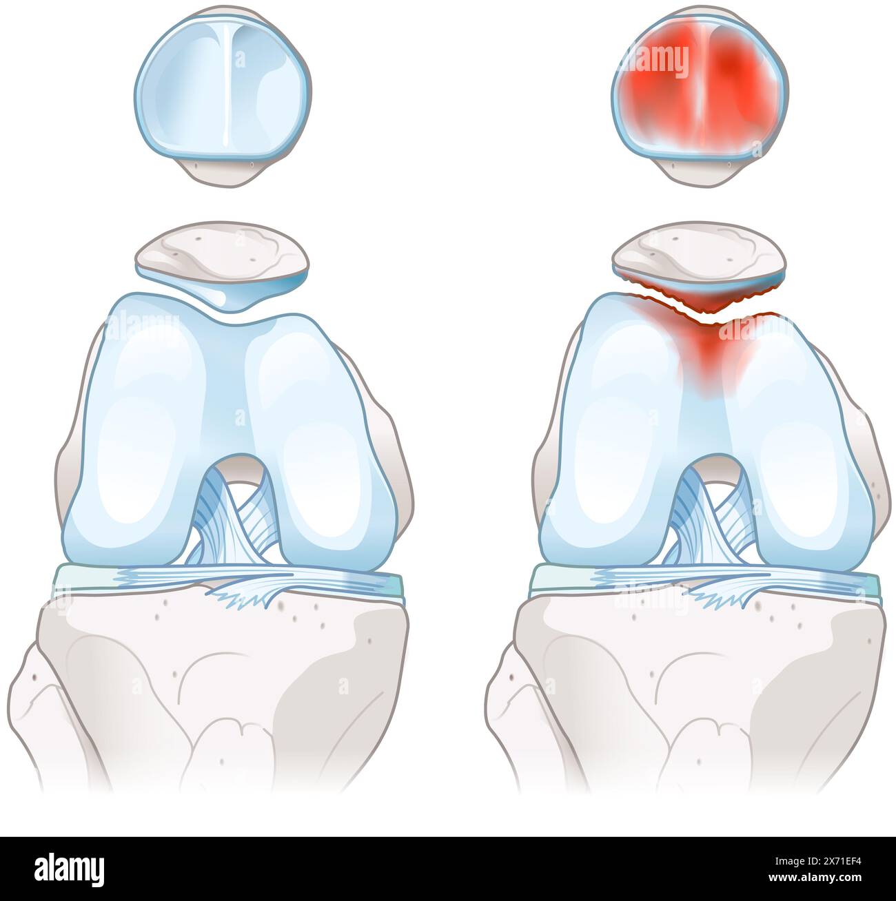 La condromalacia comporta l'ammorbidimento e il deterioramento della cartilagine, causando spesso dolore al ginocchio, infiammazione e disagio durante il movimento e l'attività Foto Stock