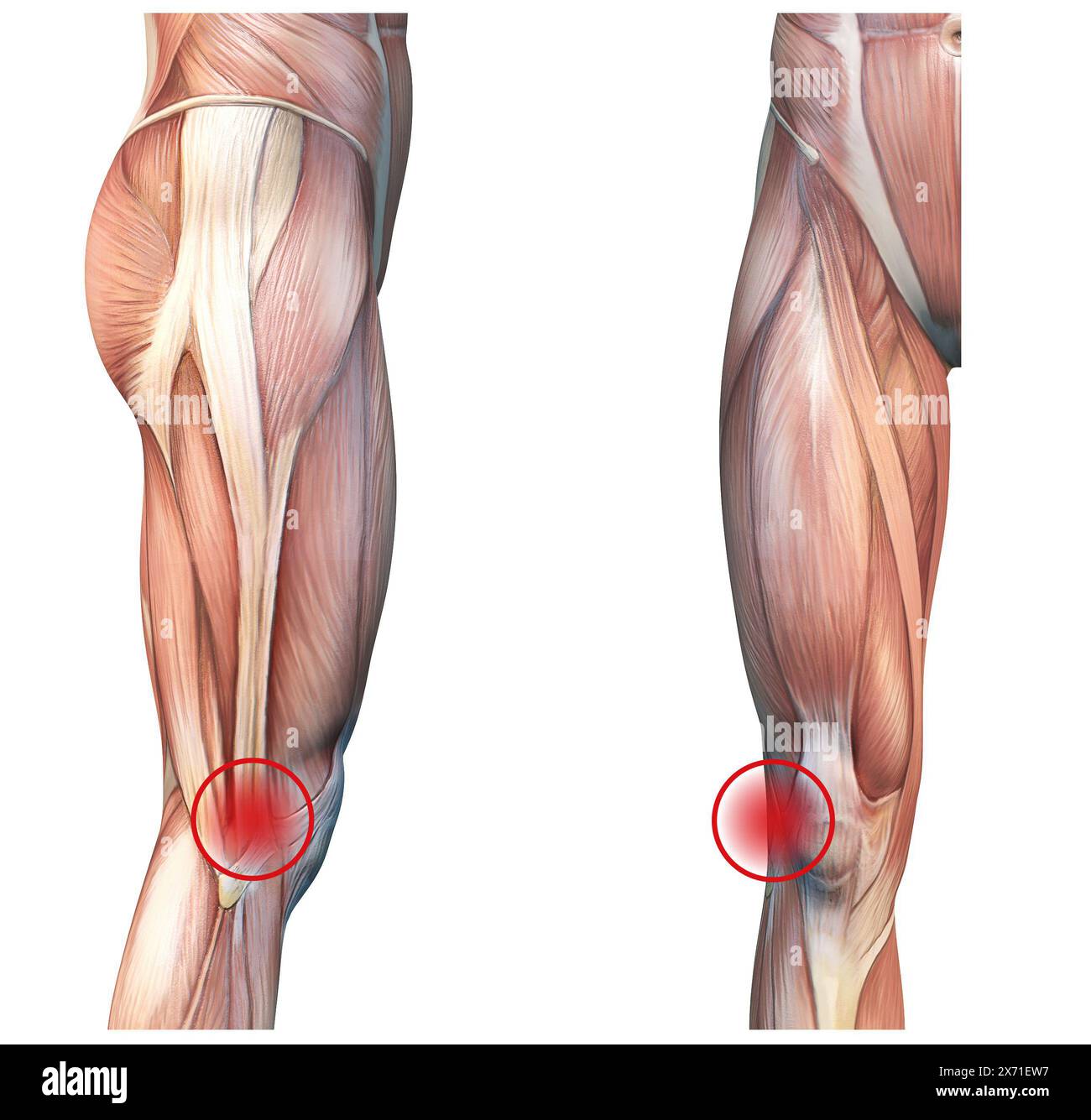 Sindrome della banda iliotibiale: Condizione del ginocchio che causa dolore all'esterno del ginocchio a causa di infiammazione o uso eccessivo Foto Stock