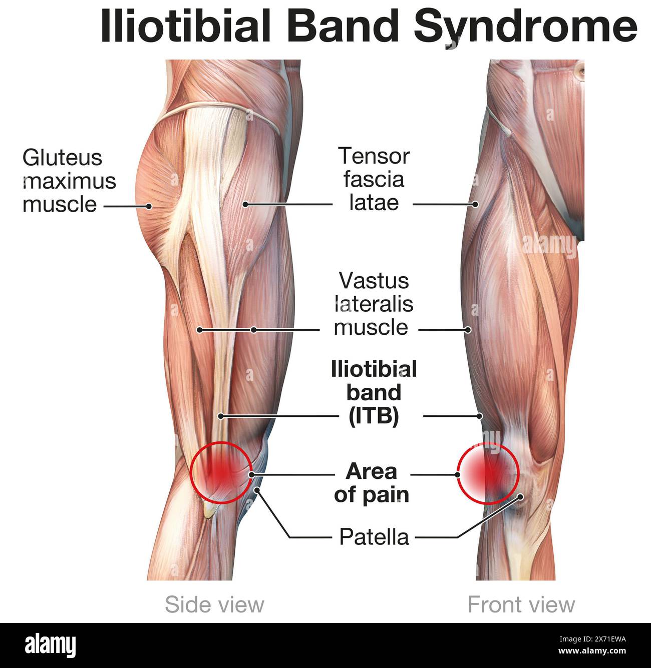 Sindrome della banda iliotibiale: Condizione del ginocchio che causa dolore all'esterno del ginocchio a causa di infiammazione o uso eccessivo Foto Stock