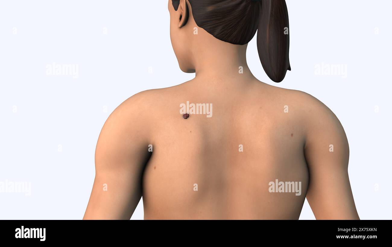 Cellule del melanoma metastatico all'interno del corpo Foto Stock