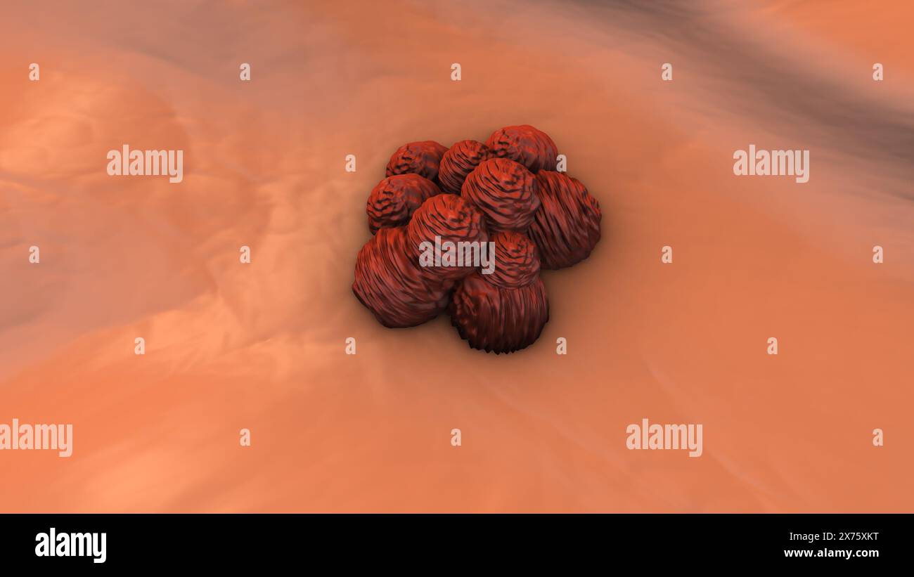 Metastasi interne delle cellule del melanoma Foto Stock