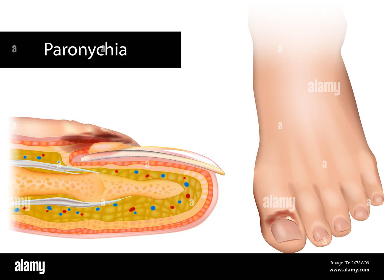 La paronicchia è un'infiammazione della pelle intorno all'unghia. Illustrazione Vettoriale