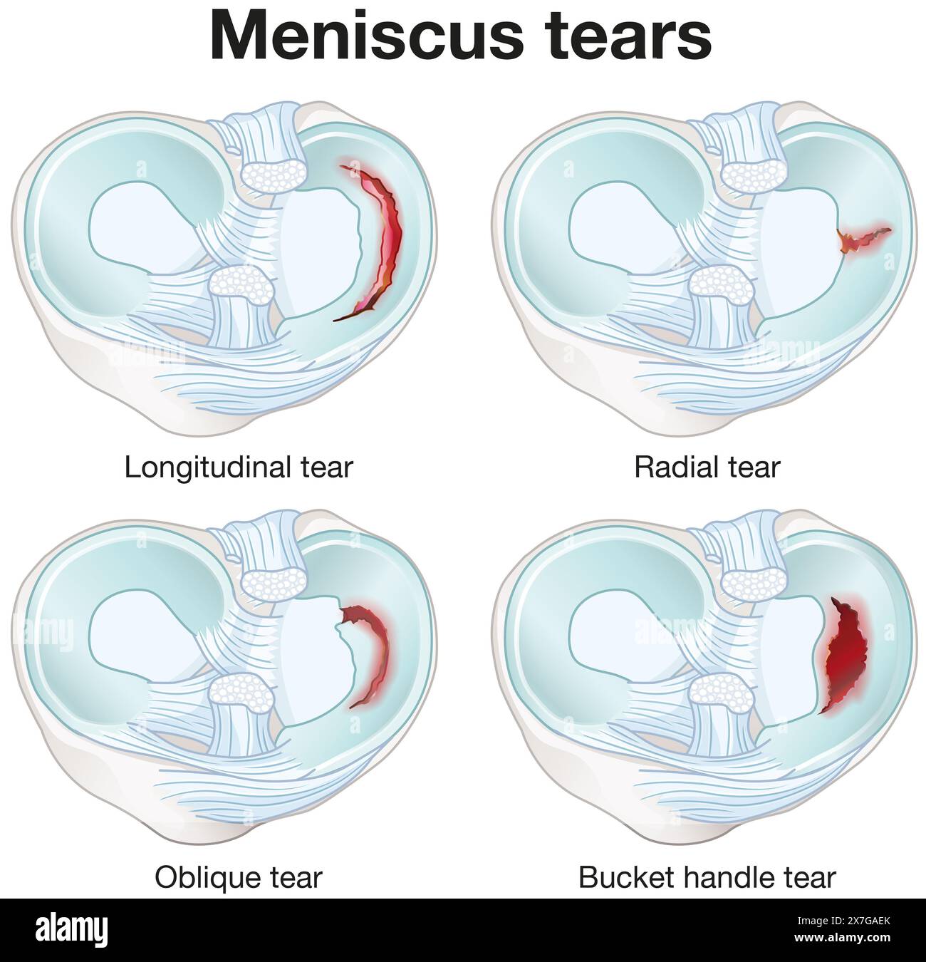 Le lacrime del menisco sono lesioni al ginocchio che causano dolore, gonfiore e movimento limitato, spesso dovute a movimenti sportivi o torsionali che richiedono un trattamento. Foto Stock