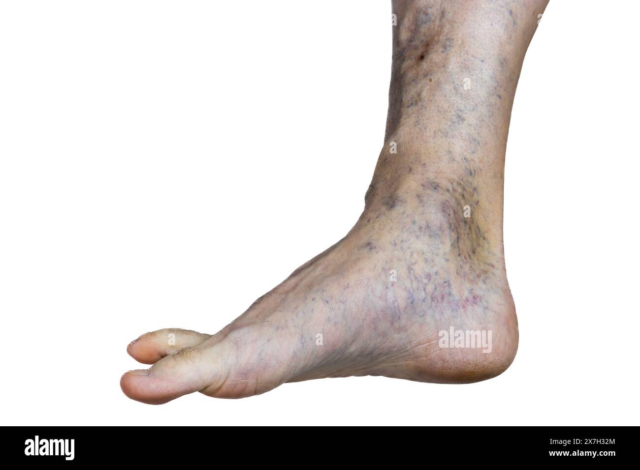 Questa immagine rivela una gamba afflitta da vene varicose pronunciate, indicando potenziali problemi del sistema circolatorio. Foto Stock