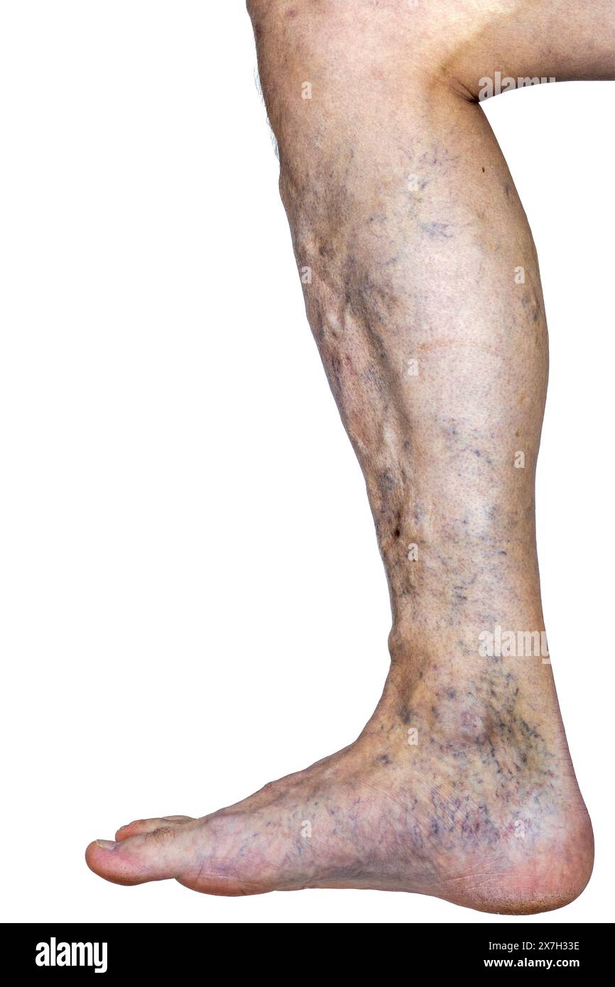L'immagine presenta una vista dettagliata di una gamba afflitta da vene varicose, che mostra le vene gonfie, ritorte e ingrandite Foto Stock
