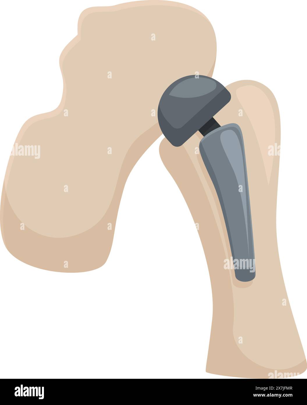 Grafica vettoriale di una sostituzione articolare dell'anca, che mostra un impianto protesico medico Illustrazione Vettoriale