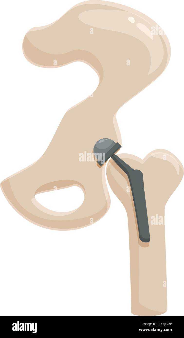 Grafico vettoriale dettagliato di una protesi dell'anca impiantata in un osso femorale Illustrazione Vettoriale
