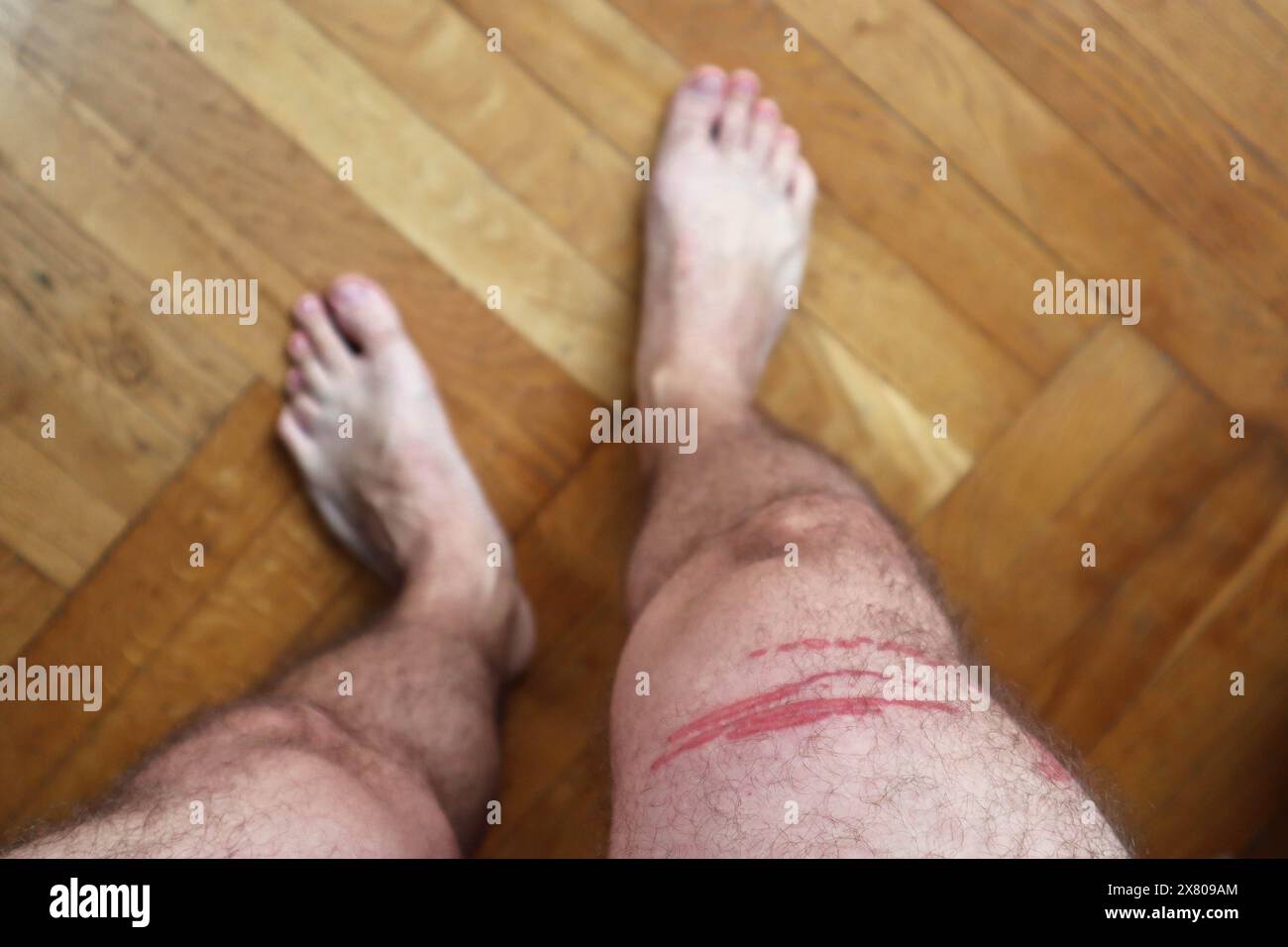 Una puntura di meduse brucia sulla gamba di un uomo Foto Stock