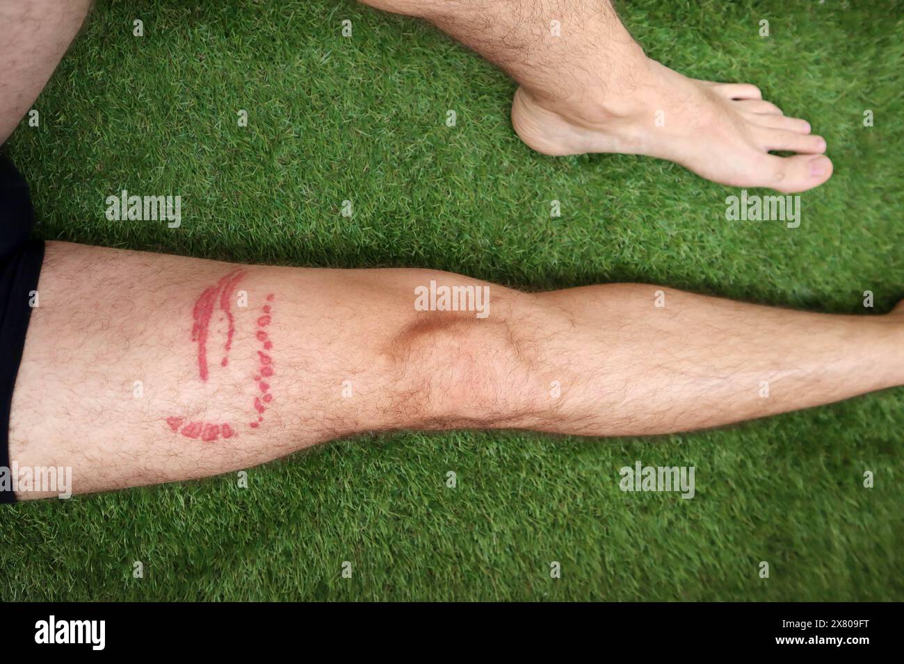 Una puntura di meduse brucia sulla gamba di un uomo Foto Stock