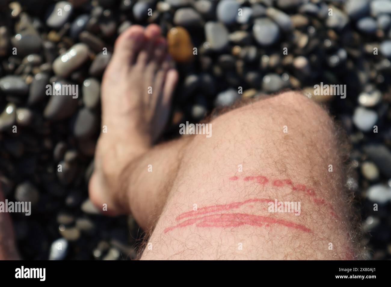 Una puntura di meduse brucia sulla gamba di un uomo Foto Stock