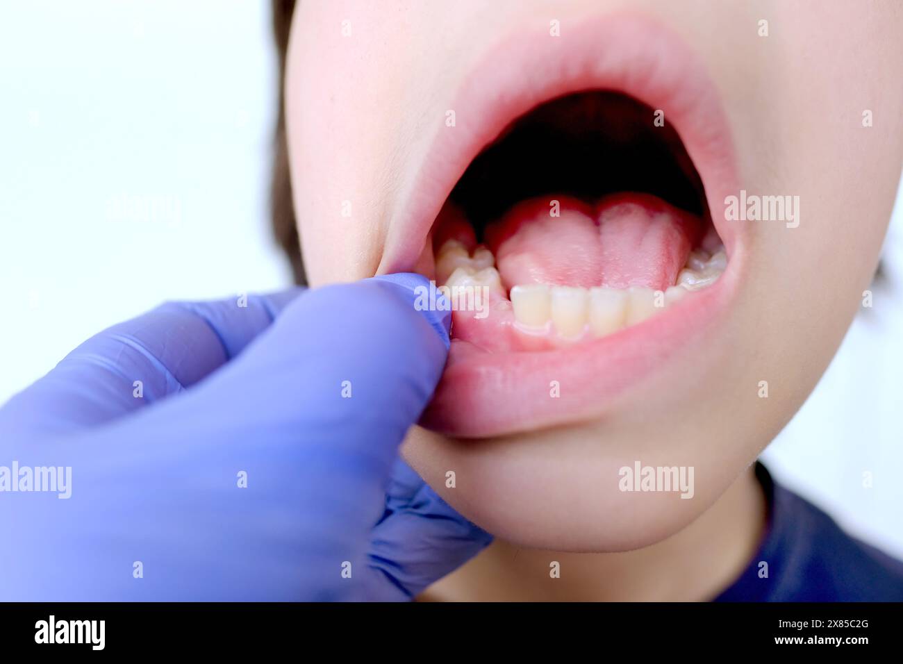 dentista, medico esamina la cavità orale di un piccolo paziente, primo piano di un bambino di 10 anni, nozione odontoiatria pediatrica, trattamento dentale, correzione Foto Stock