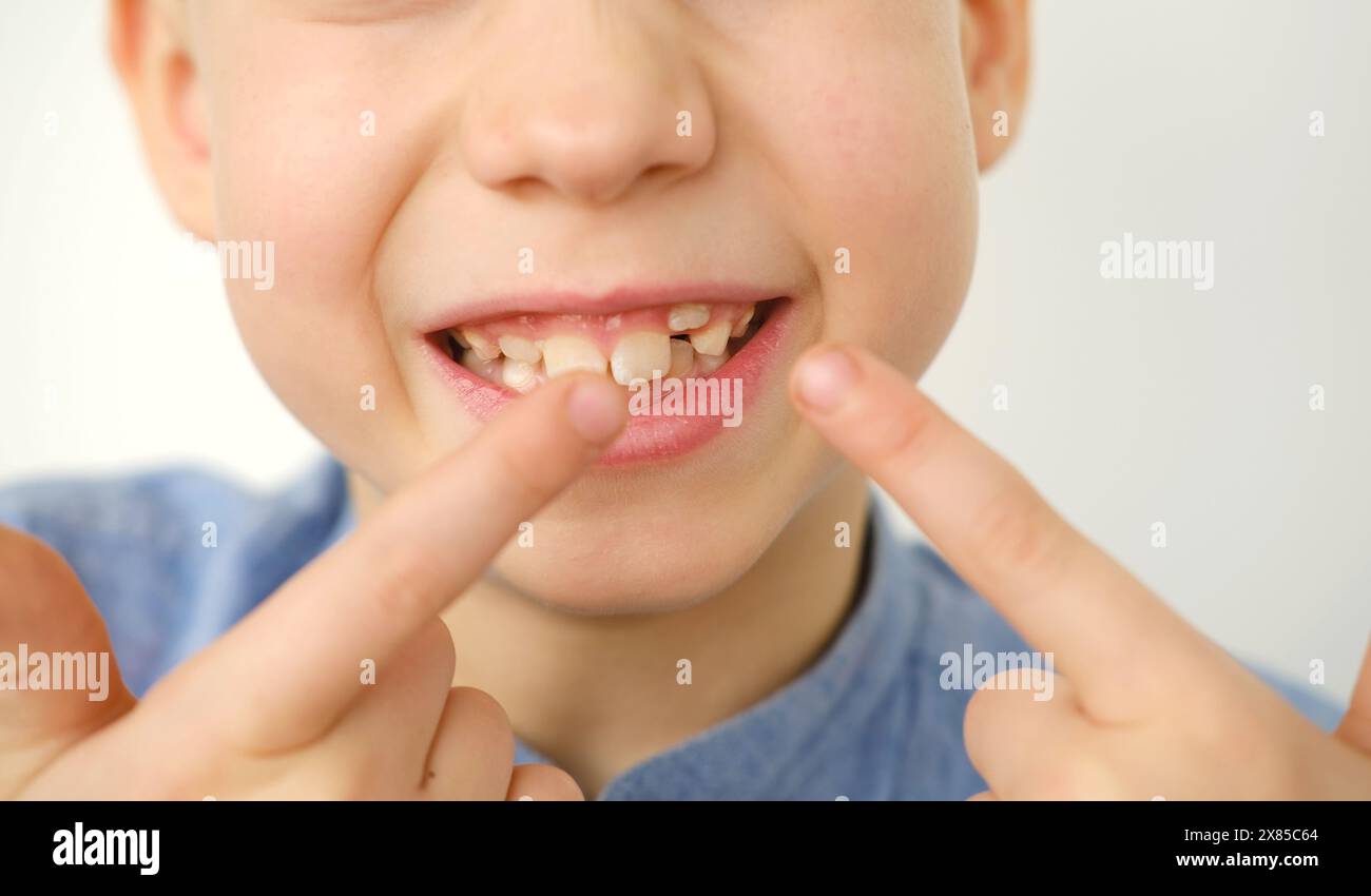 primo piano mano di bambino, ragazzo di 9 anni punta nuovo dente fang in bocca con il dito, concetto di salute dei bambini, odontoiatria pediatrica, corre dentale Foto Stock