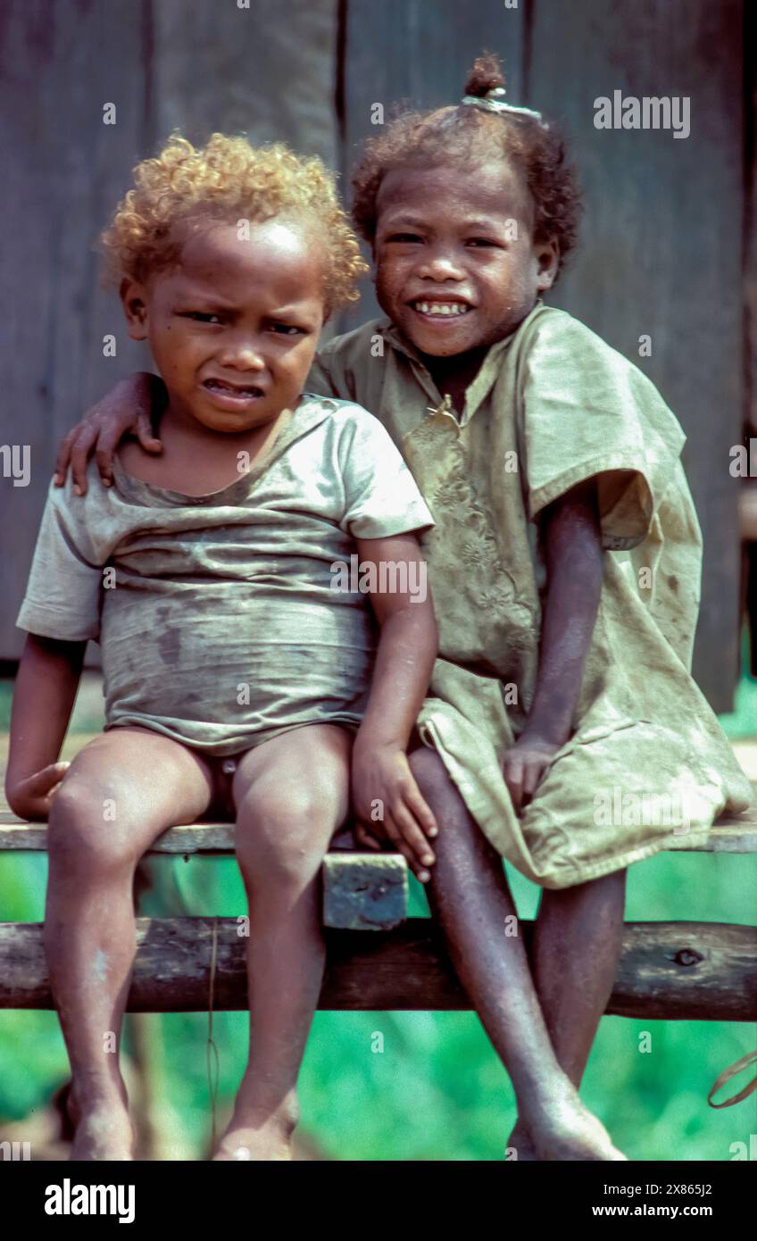 Engels Filippine, Manila, fratello e sorella entrambi con una carenza di zinco. In questo modo si schiarisce il colore dei capelli e si causano problemi alla pelle. Foto Stock