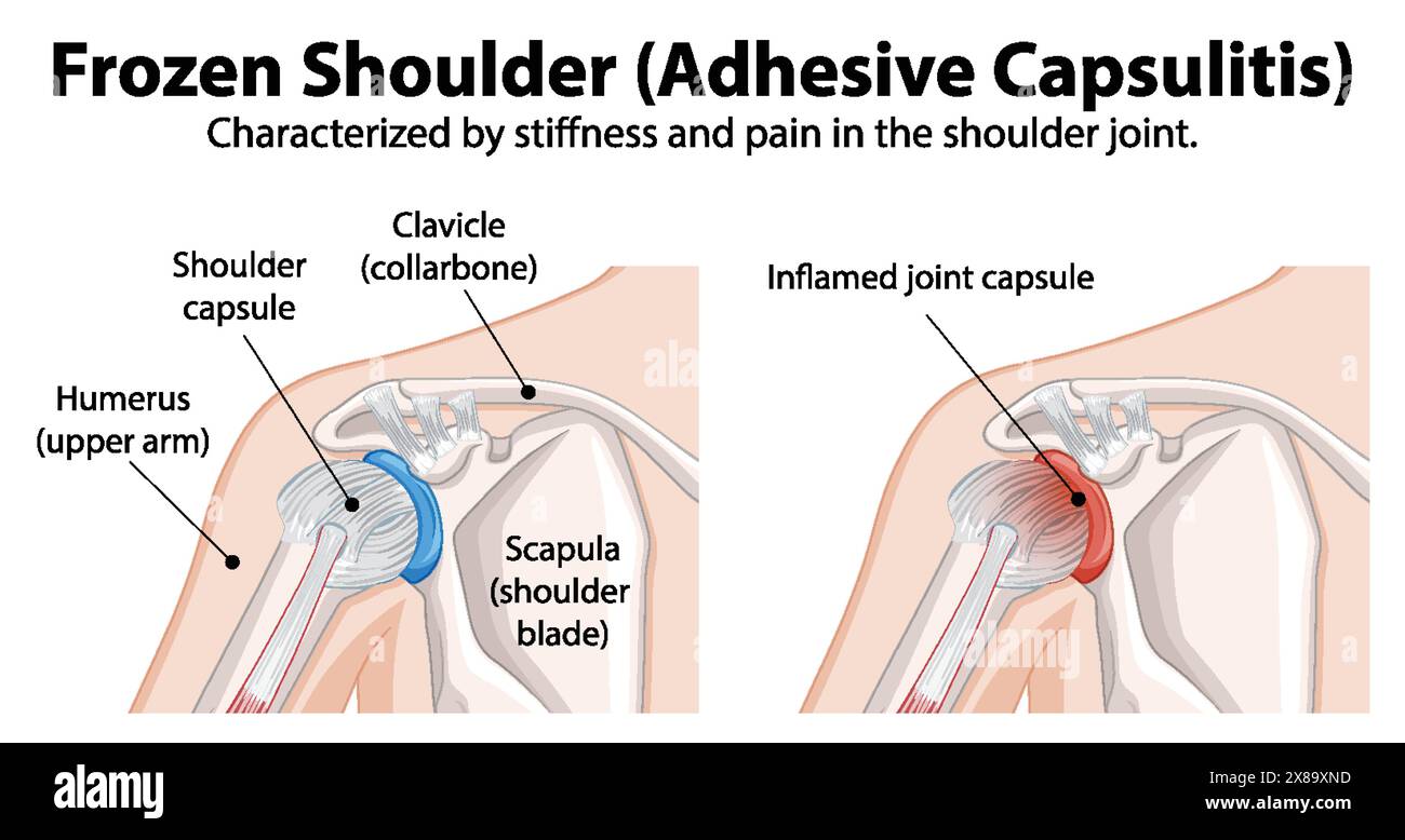 Diagramma che mostra l'anatomia e l'infiammazione della spalla congelata Illustrazione Vettoriale