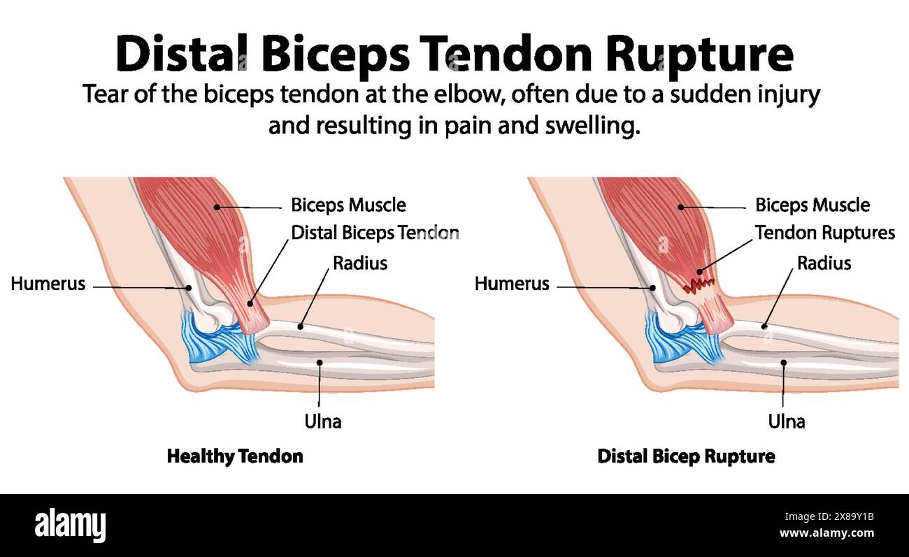 Confronto di tendine bicipiti sani e rotti Illustrazione Vettoriale