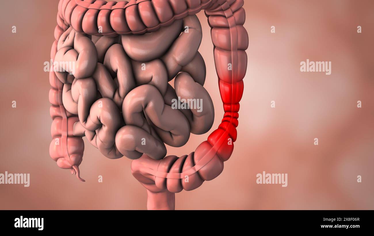 Un disturbo intestinale che causa dolore allo stomaco Foto Stock