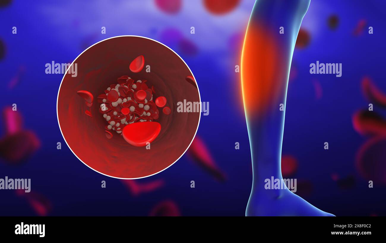 Concetto di dolore ai piedi periferici con coaguli di sangue Foto Stock