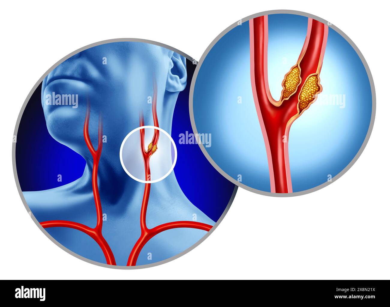 Malattia dell'arteria carotide come arterie che portano il flusso di sangue al cervello è intersecato da aterosclerosi come placca si accumulano all'interno del vaso bloccato cau Foto Stock