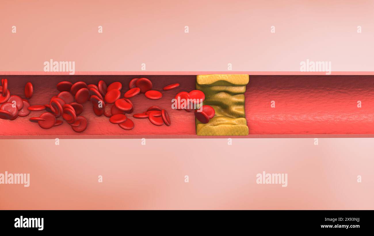 Animazione medica del coagulo di sangue dell'arteria Foto Stock