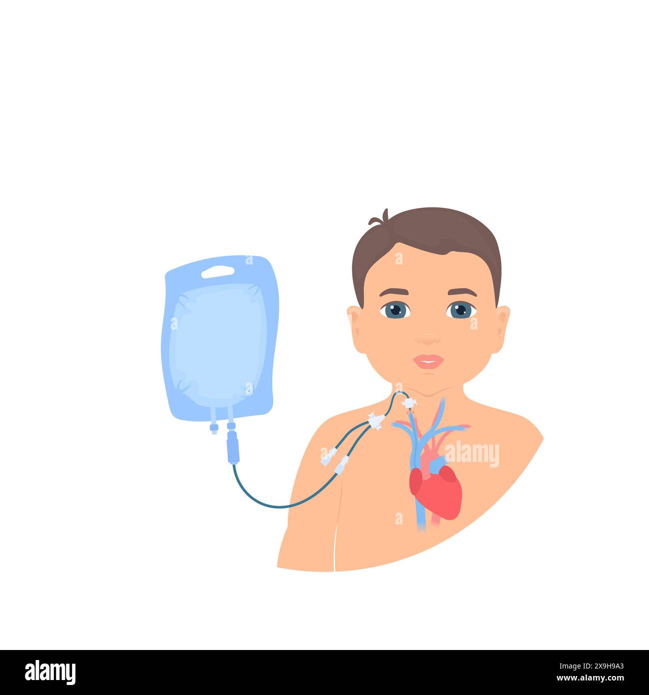 Illustrazione che mostra un bambino che riceve nutrizione parenterale attraverso un catetere nella vena giugulare interna. Questo metodo prevede la somministrazione di nutrienti direttamente nel flusso sanguigno, bypassando completamente il sistema digerente. Viene utilizzato quando una persona non è in grado di ottenere un'alimentazione adeguata attraverso vie orali o enterali (intestino). Foto Stock