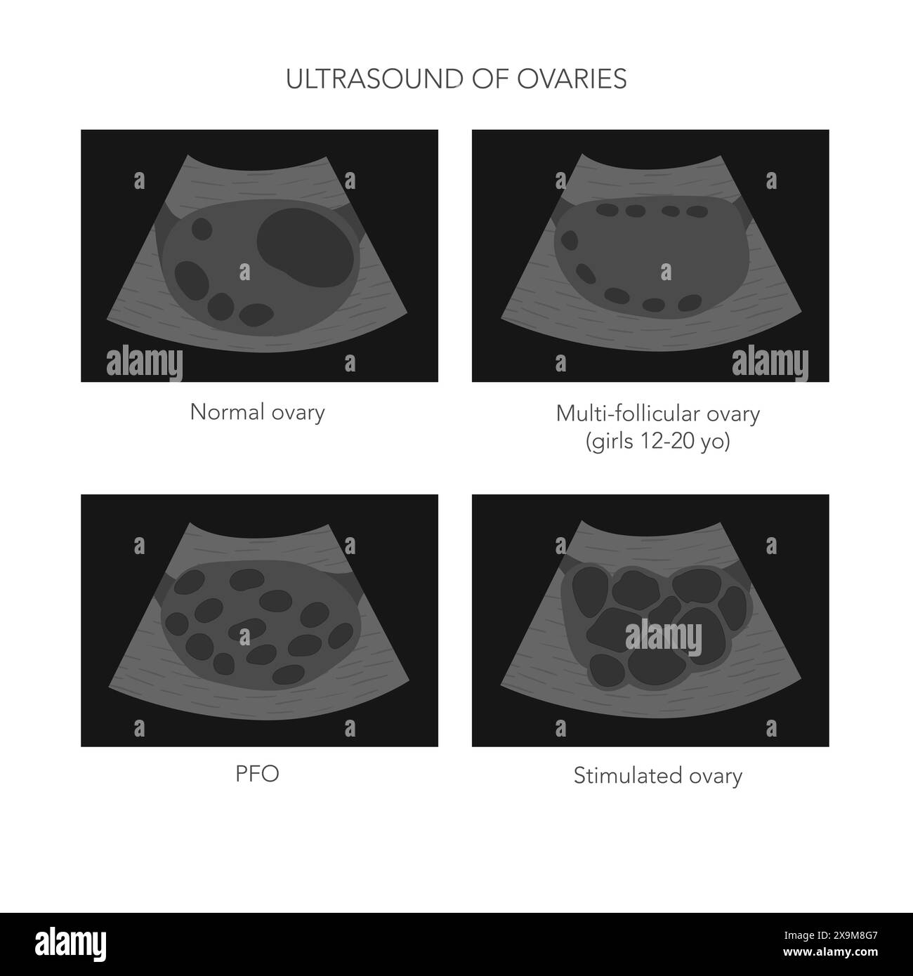 Illustrazione vettoriale medica di ecografia ovarica con immagini ovariche normali, policistiche e stimolate. Illustrazione vettoriale Illustrazione Vettoriale